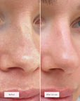 SALICYLIC ACID EXFOLIANT