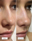 NOSE PATCHES
