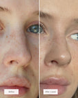 NOSE PATCHES