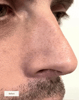 NOSE PATCHES