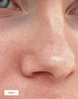 SALICYLIC ACID EXFOLIANT